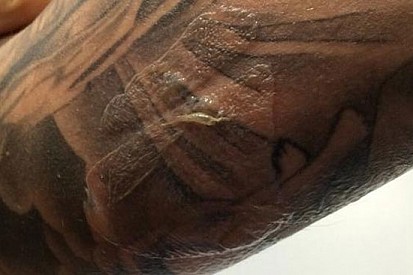 Hector Barbera posta la foto del suo braccio bruciato