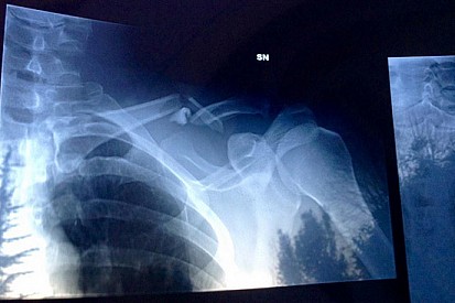 Zanardi si frattura una clavicola con la handbike